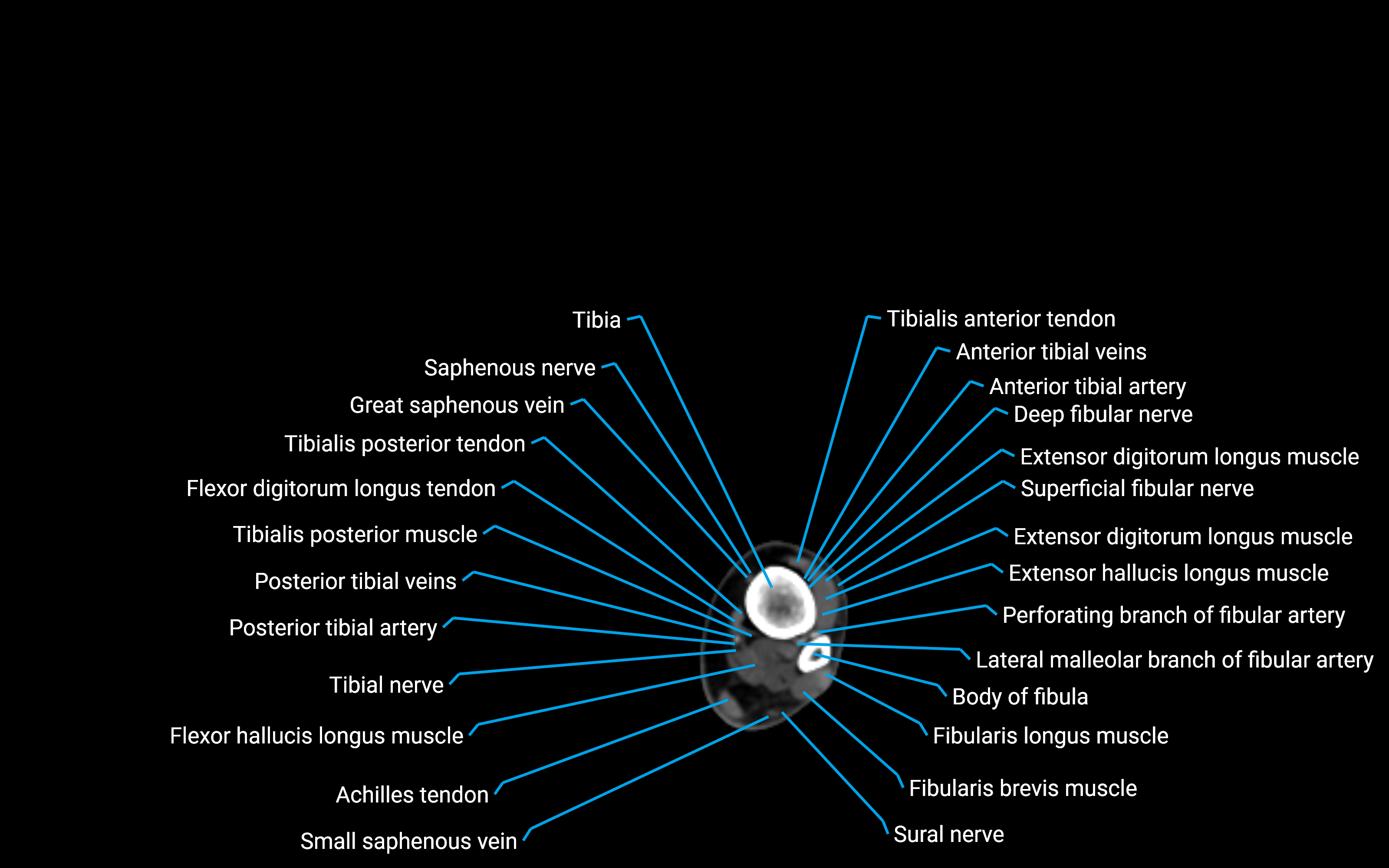 CT Lower leg axial cross sectional anatomy labelled image 159 (2).png